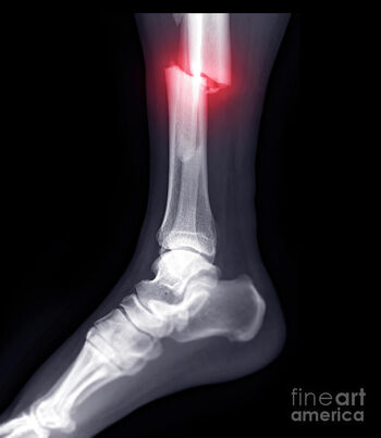 brokenleg
